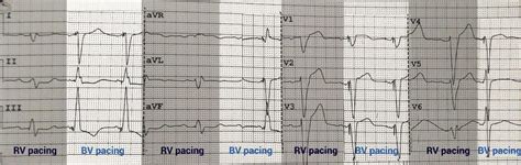 lv attachment|lv lead placement.